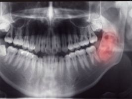 Quistes y Tumores de los maxilares